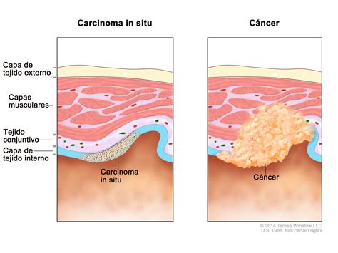 Definici N De Carcinoma In Situ Diccionario De C Ncer Del Nci Nci