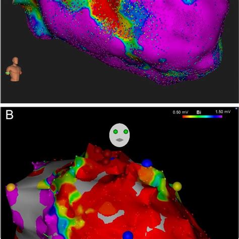 Ultra High Density Mapping And Left Ventricular Ejection Fraction