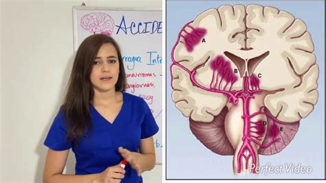 Accidente cerebrovascular fisiopatología del ACV isquémico y