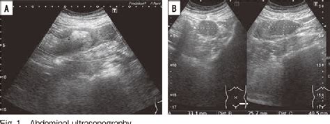 Figure From A Case Report Of Intussusception Caused By An