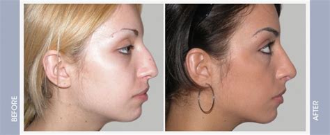 Cartilage Nose Job Before And After