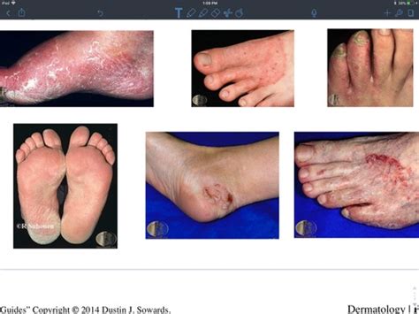 Gnmp Derm Fungal Infections Flashcards Quizlet