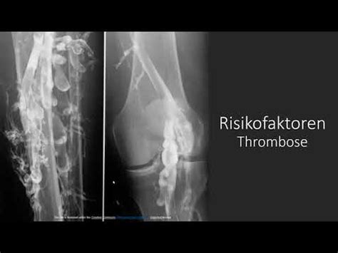 Thrombose Thromboserisiken Einfach Erkl Rt Zusammenhang Zwischen