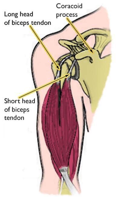 BICIPITAL TENDINITIS — Miami Bone & Joint Institute | Premier Center For Upper And Lower Extremity