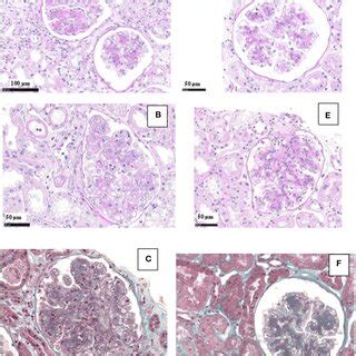 Immunofluorescence Findings In Patient 1 The First Biopsy Showed