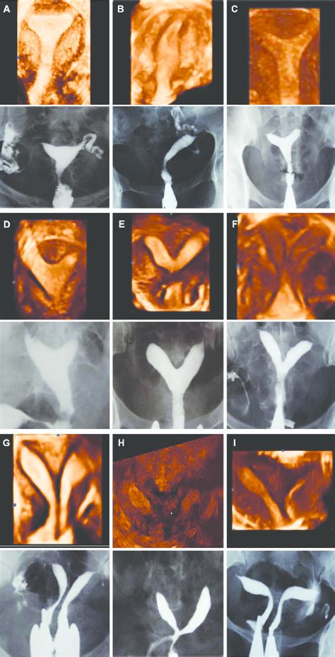 Comparison Of Three Dimensional Ultrasound And Hsg Imaging In Cases Of