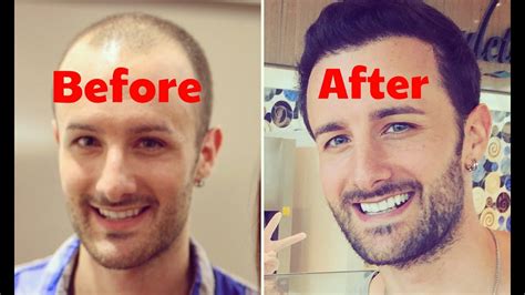 Jamie Foxx Hairline Surgery Before And After Photos 2018