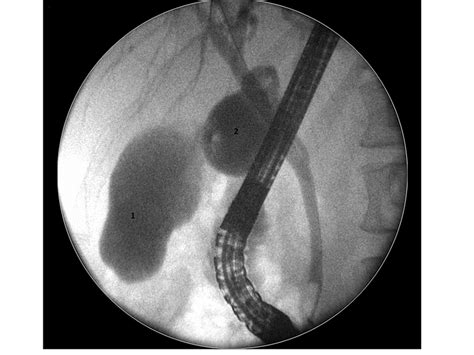 Endoscopic Retrograde Cholangiopancreatography Cholangiogram Shows