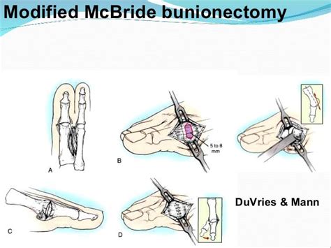 Disorders Of The Hallux