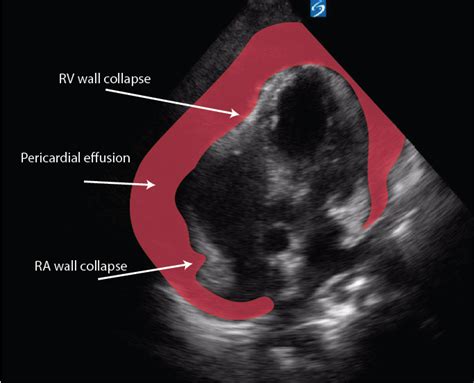 Large Pericardial Effusion Critical Care Sonography