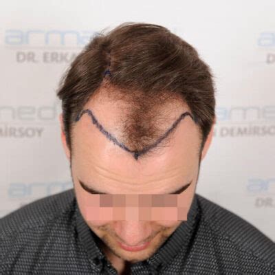 Hair Transplant Guide 2024 Costs Turkey Before After