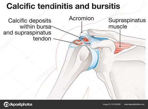 Illustration Showing Calcific Tendinitis Calcific Bursitis Stock ...