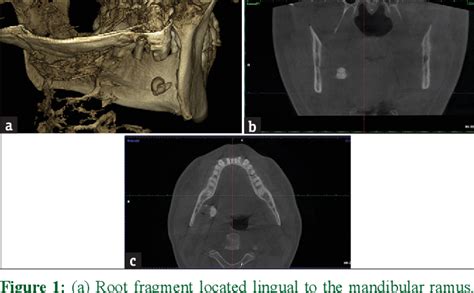 Figure From Accidental Displacement Of Mandibular Third Molar Roots