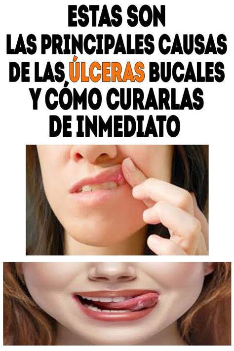 Estas Son Las Principales Causas De Las Ulceras Bucales Y Como Curarlas