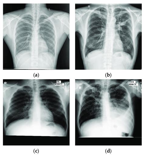 Examples Of Chest X Ray Images From Chn Datasets A Normal Chest Download Scientific Diagram