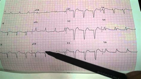 Severe Substernal Chest Pressure Ekg Electrocardiogram Ecg Dr Uri Ben Zur Md Youtube