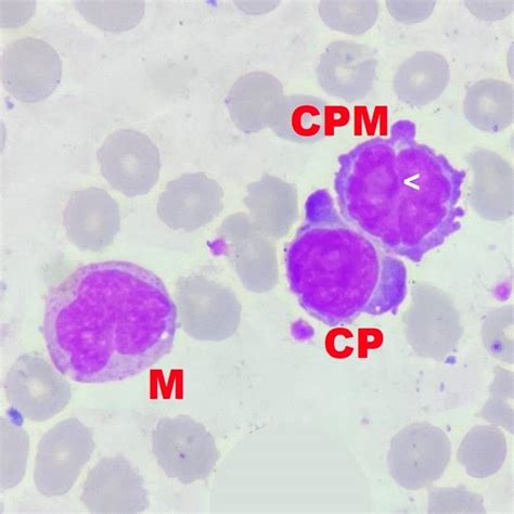 Leucemia de células plasmáticas con morfología monocitoide imágenes