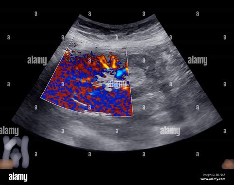 Ultrasound Upper Abdomen Showing Kidney Stock Photo Alamy