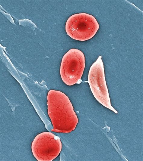 Sickle Shaped Red Blood Cell Hot Sex Picture