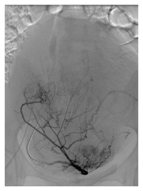 Left A And Right B Uterine And C Right Ovarian Arteriographic