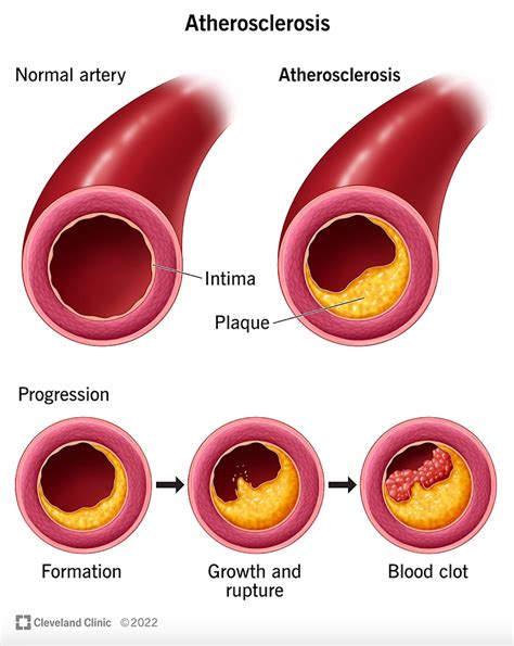 Macromo | Coronary Artery Disease