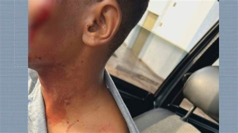 Jovem Agredido Pedra E Garrafa Enquanto Esperava Nibus Para Ir