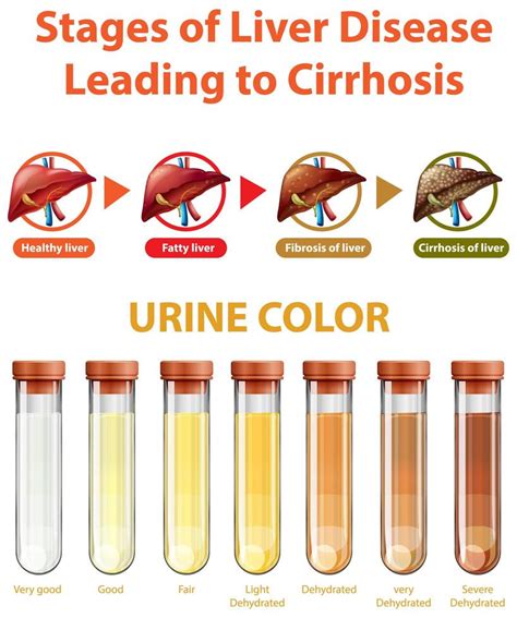 Liver Disease Urine Colour Infoupdate Org