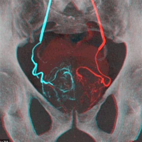 Embolisation Of The Prostatic Arteries Pkli Rc