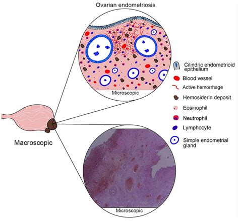 Ovarian Cyst Histology