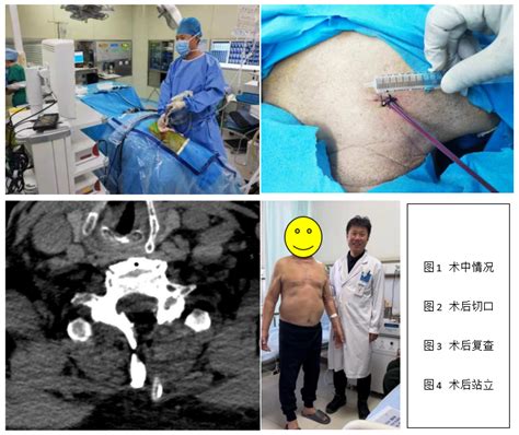 小切口巧治下肢瘫痪 哈医大一院骨科安刚教授团队成功实施脊柱内镜下微创技术助75岁老人快速康复胸椎管狭窄哈医大骨科内镜脊柱切口 健康界