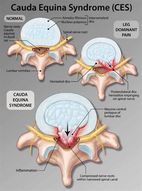 Cauda Equina Syndrome Pain - Carolinas Pain Center