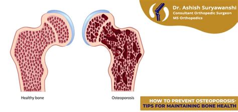 How To Prevent Osteoporosis Tips For Maintaining Bone Health Dr