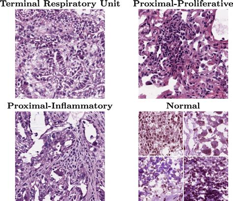 Classification Of Lung Adenocarcinoma Transcriptome Subtypes From