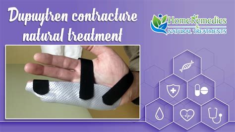 Dupuytrens Contracture Natural Treatment Natural Treatments And