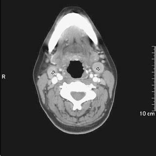 CT scan of the neck: arrows ( ↑ ) show enlarged palatine tonsils... | Download Scientific Diagram