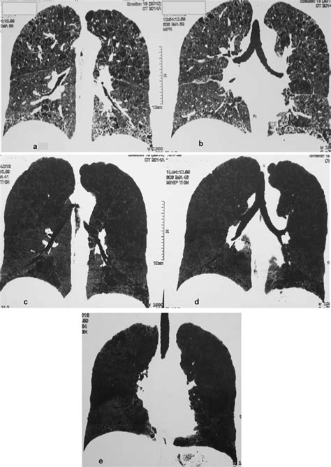 A E A 48 Year Old Female Patient Complaining Of Dyspnea On Mild