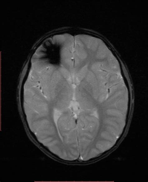 Cerebral Cavernous Venous Malformations Image Radiopaedia Org Hot Sex Picture