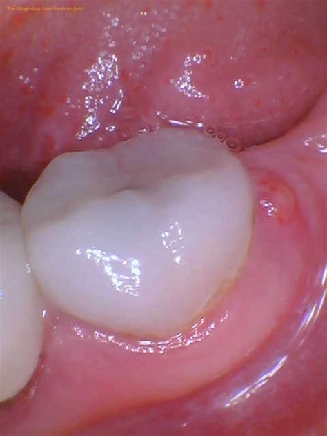 Periapical Abscess With Sinus Vs Without Sinus 1311 Jackson Ave