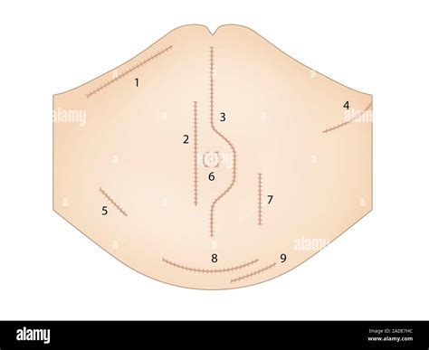 Abdominal Surgery Incisions Illustration 1 Kochers Incision Liver