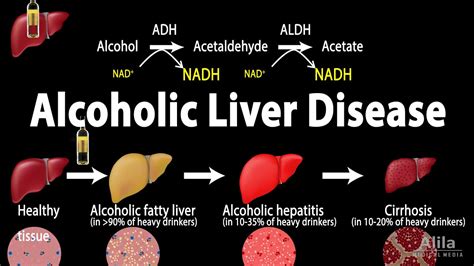 Alcoholic Liver Disease