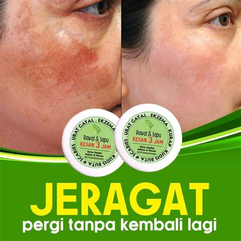 Krim Ubat Gatal Kurap Eczema Psoriasis Itchy Skin Fungal Dermatitis Ubat Krim Gatal Sakit Kulit ...