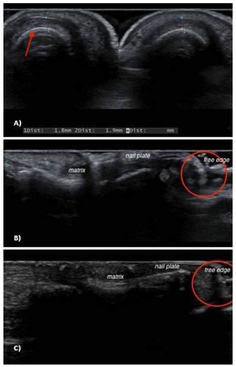 Sonographic Features of Onychopapilloma: A Single Center Retrospective