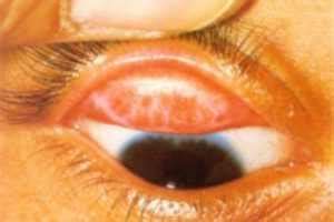 Trachoma: Definition, Signs and Treatment