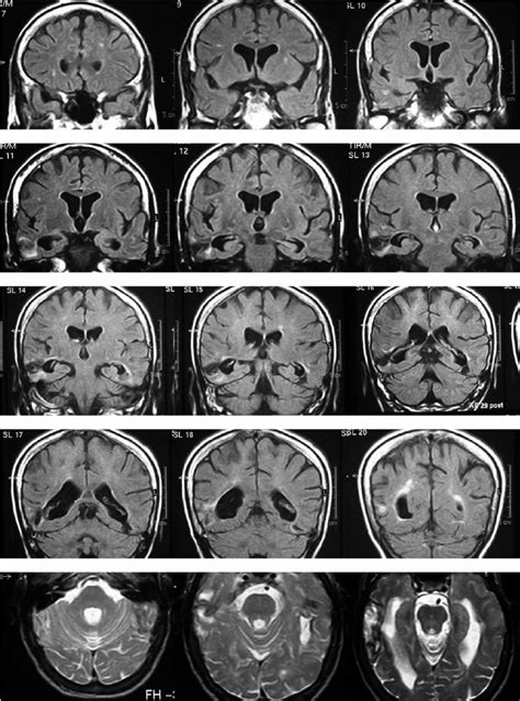 Magnetic resonance imaging (MRI) images showing the temporal lobe ...