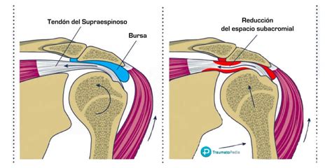 Rotura De Los Tendones Del Hombro Manguito De Los Rotadores