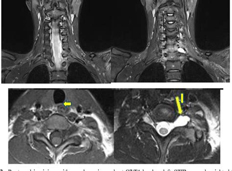 Figure 1 From Magnetic Resonance Imaging Of Adult Traumatic Brachial