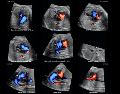 Color And Power Doppler Combined With Fetal Intelligent Navigation