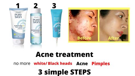 Acne Treatment Oriflame Pure Skin Purifying Face Wash Toner And Sos Spot Gel Review Flawless