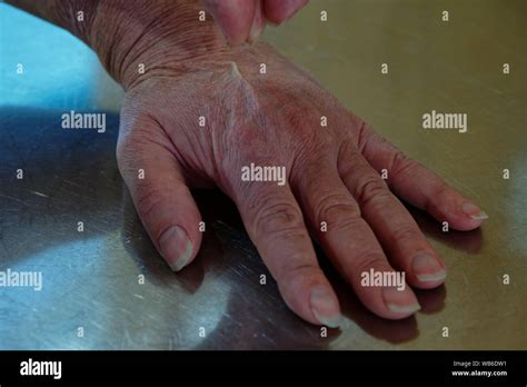 Skin turgor test hi-res stock photography and images - Alamy