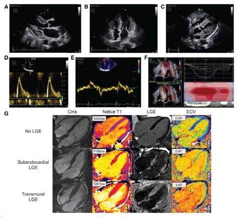 Typical Echocardiography And Cardiac Magnetic Resonance Cmr Findings